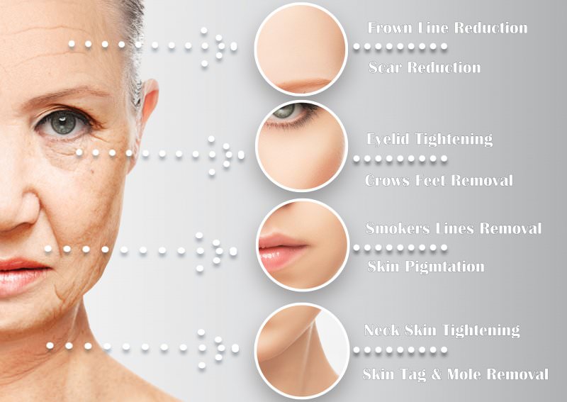 What Is Plasma Fibroblast Therapy? Benefits, Safety & How It Works